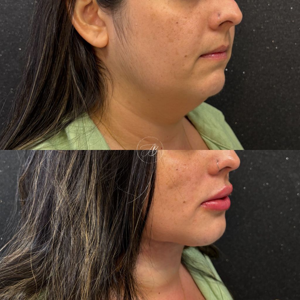 Antes e depois: mandíbula definida e pescoço esculpido