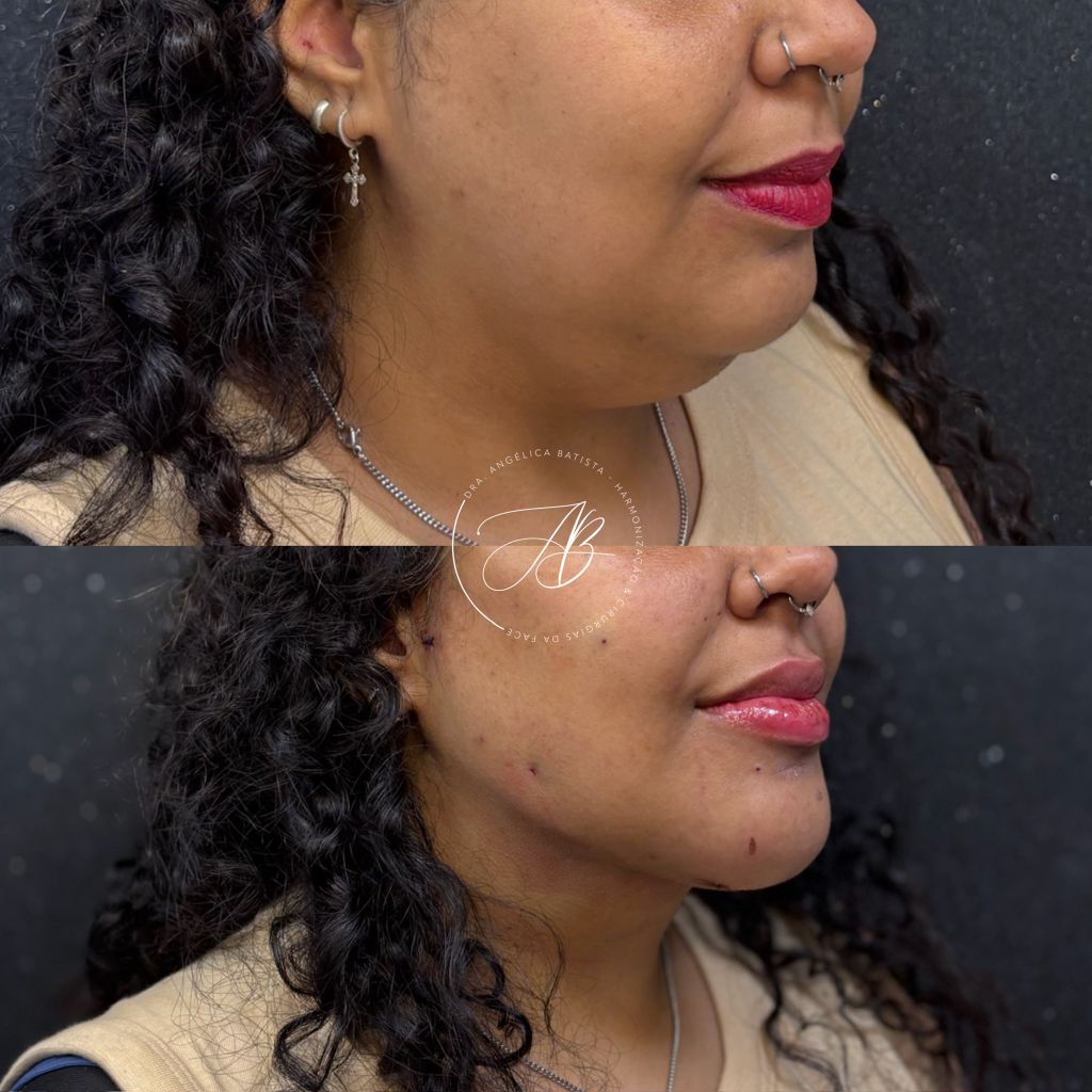 Antes e depois: lipoaspiração cervical com refinamento do contorno facial