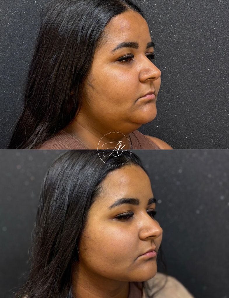 Antes e depois: pescoço alongado e rejuvenescido