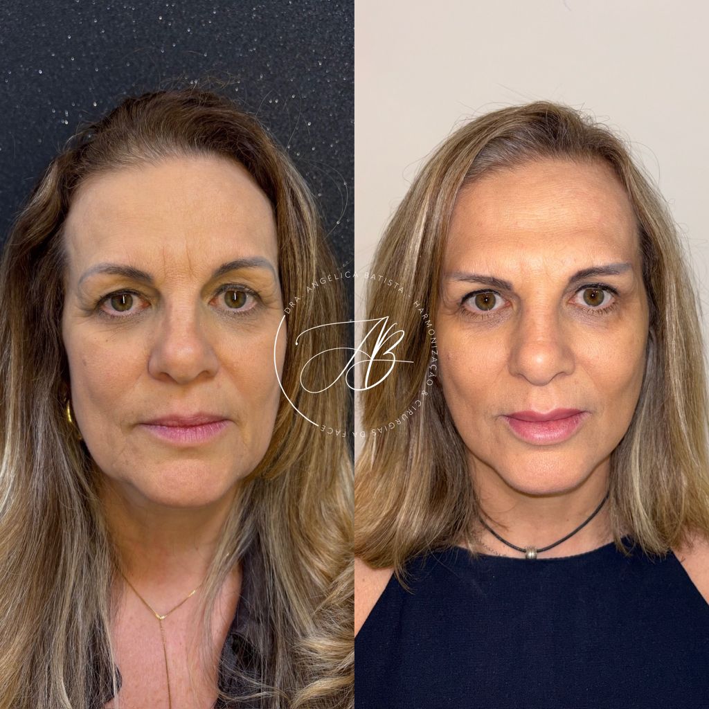 Antes e depois: definição de contorno (perfil)