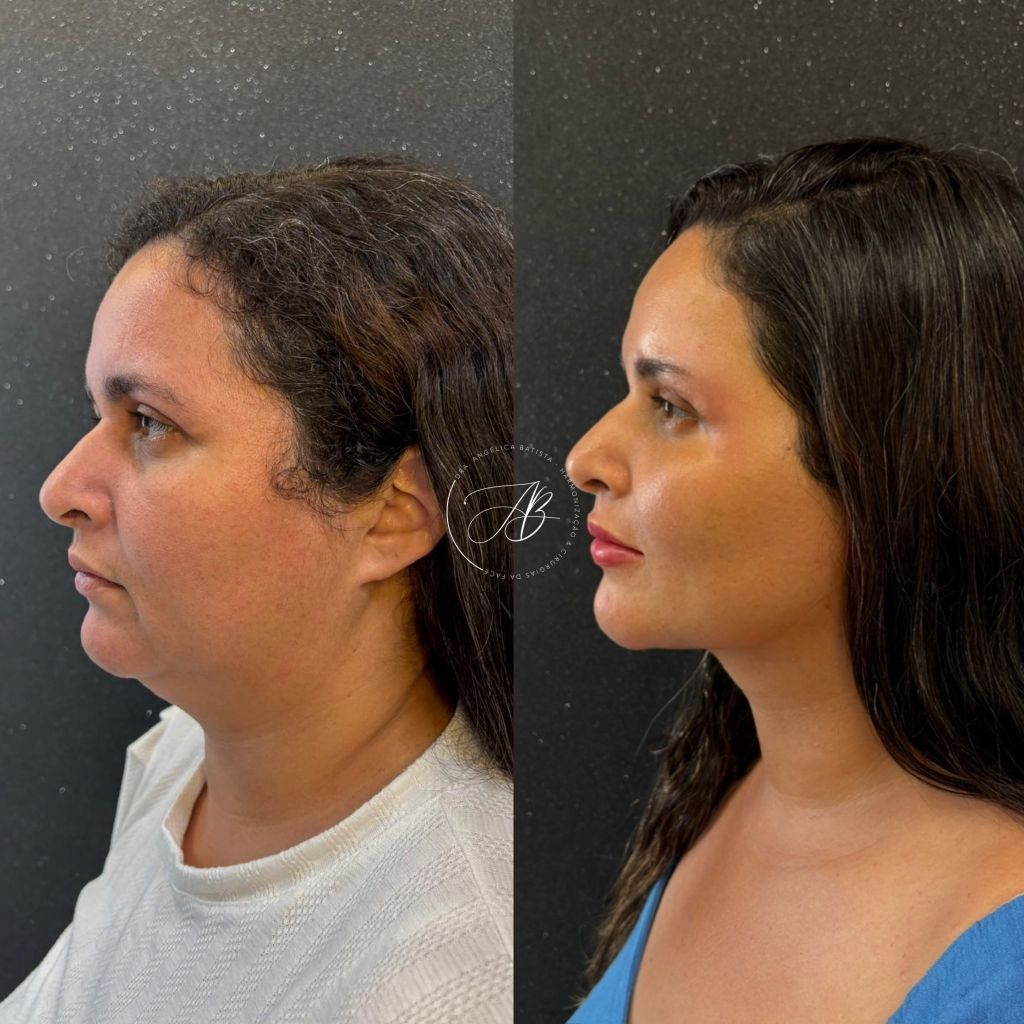 Antes e depois: lipoaspiração cervical + cervicoplastia — caso real