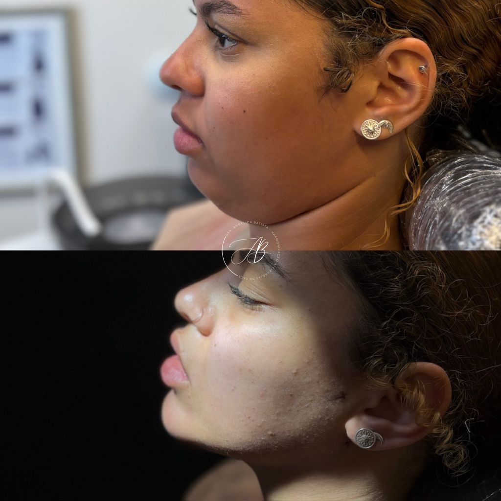 Antes e depois: lipoaspiração de papada cirúrgica — perfil redefinido