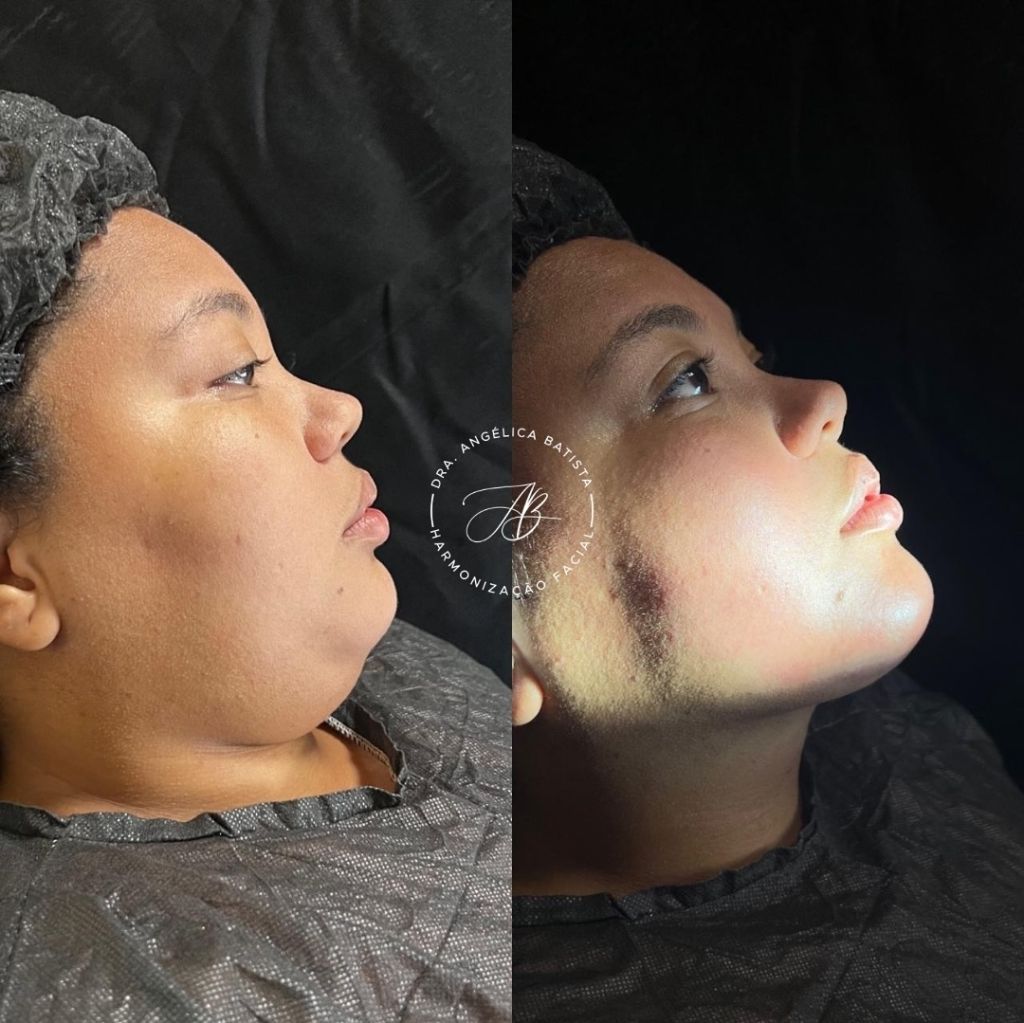 Exemplo real: lipoaspiração de papada (cirúrgica) — antes e depois