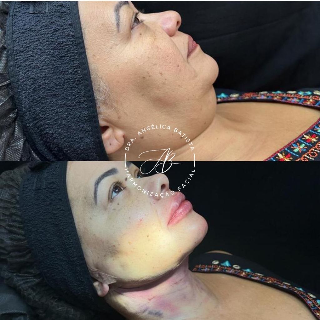 Exemplo real: platismoplastia — melhora de bandas do pescoço