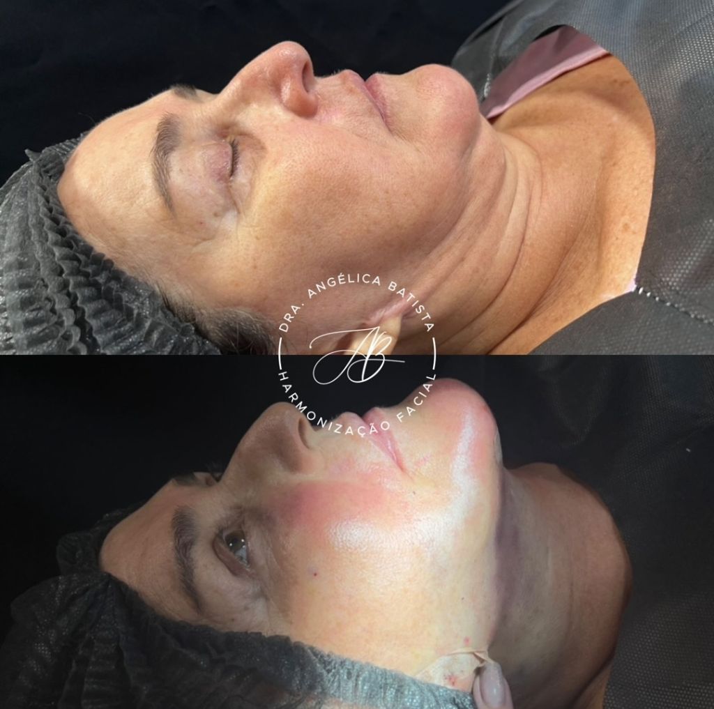 Exemplo real: cervicoplastia — rejuvenescimento cervical