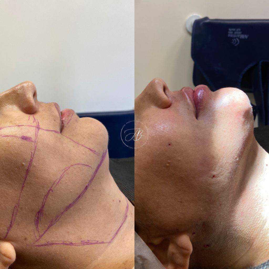 Planejamento cirúrgico: marcações pré-operatórias para resultados precisos